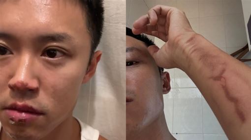 昔飆粗口清空IG　31歲男星慘被燒傷險毀容