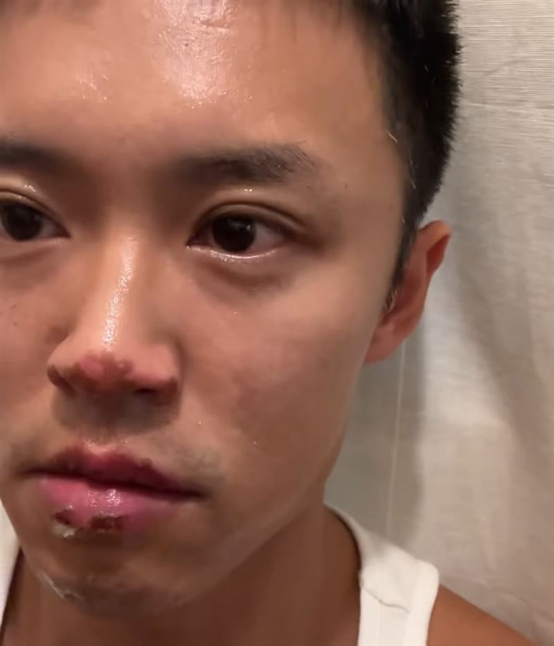 顧定軒上傳受傷照片。（圖／翻攝自IG）