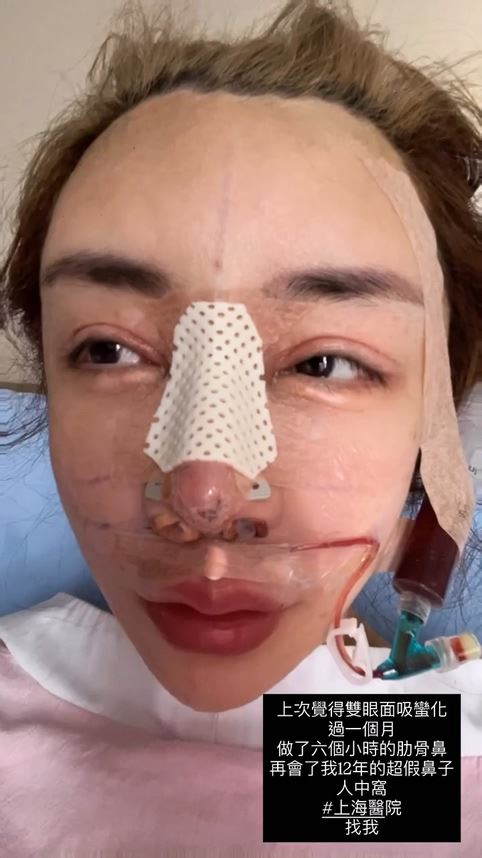 雪碧分享術後成果。（圖／翻攝自雪碧IG）