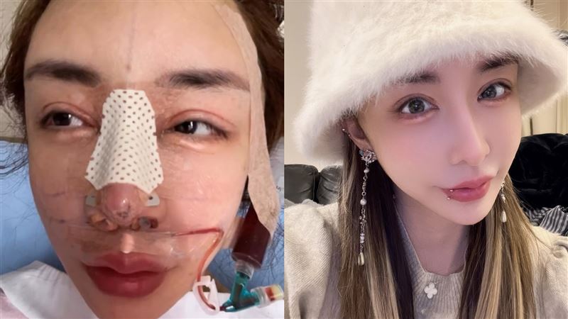 雪碧才自爆整形失敗　再動刀震撼畫面流出