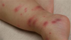 忽略這事…爸染皮蛇害不到1歲女兒長水痘　妻後來也中鏢！（圖／台中慈院提供）