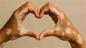 皮膚長白斑無藥可醫？什麼是白斑？如何停止擴散？治療方式一次看清！（圖／醫健新聞網提供） 