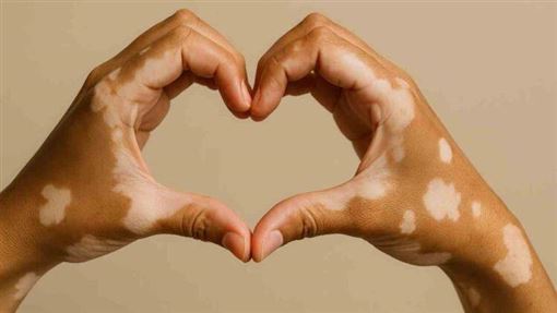 白斑治療兩階段！皮膚科醫揭關鍵策略！