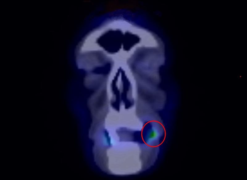 黃姓男子左側臉頰黏膜已有約2&times;1.5公分腫瘤，確診為口腔癌第二期。(圖／光田醫院提供)
