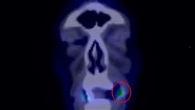 嘴破三個月沒好，竟罹癌，53歲男拖延就醫，確診口腔癌(圖／光田醫院提供)