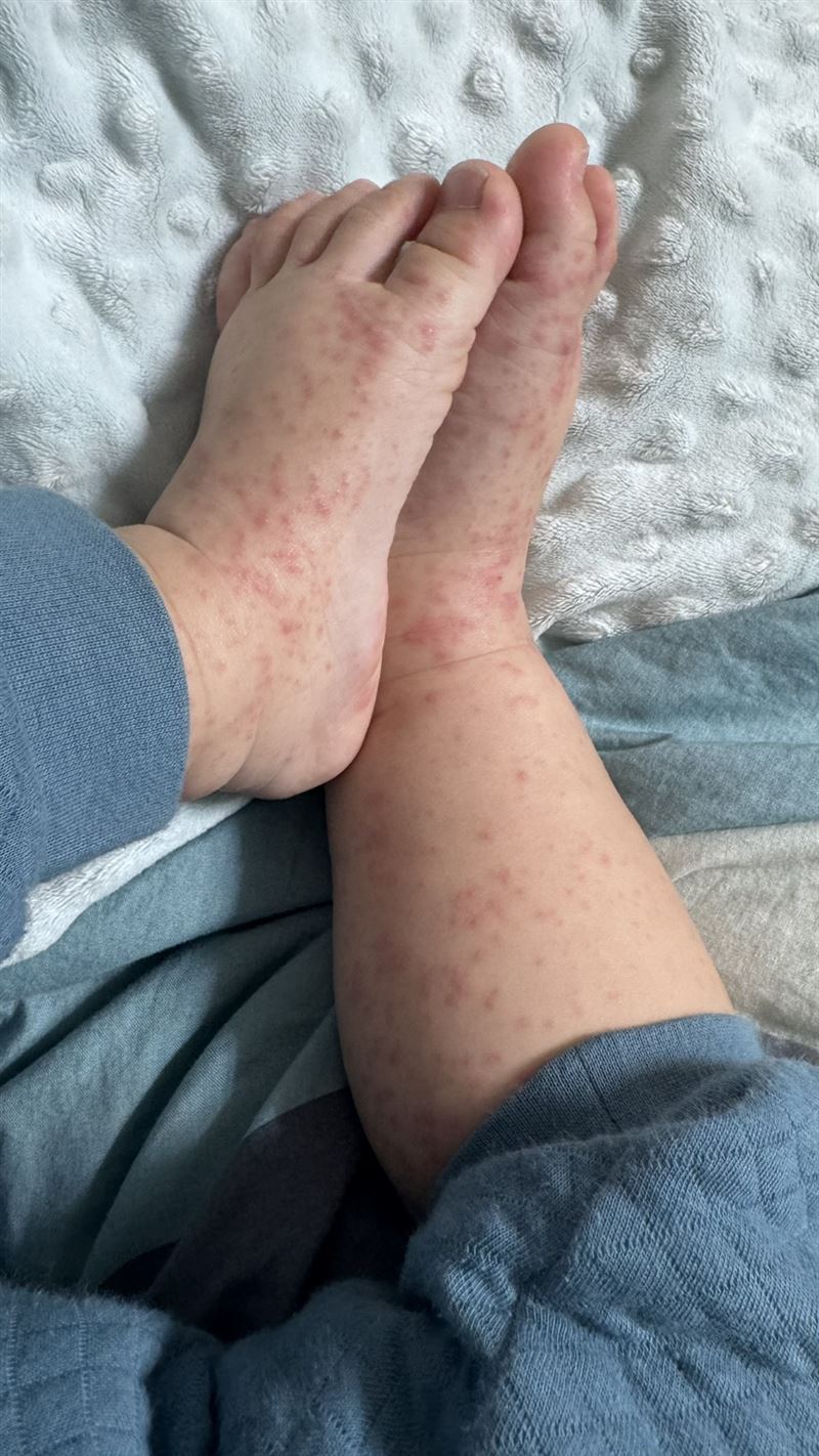 學童的手腳出現腸病毒典型症狀。（圖／家長提供）