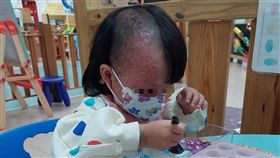 陽光基金會,微血管畸形,印記(圖／陽光基金會提供）