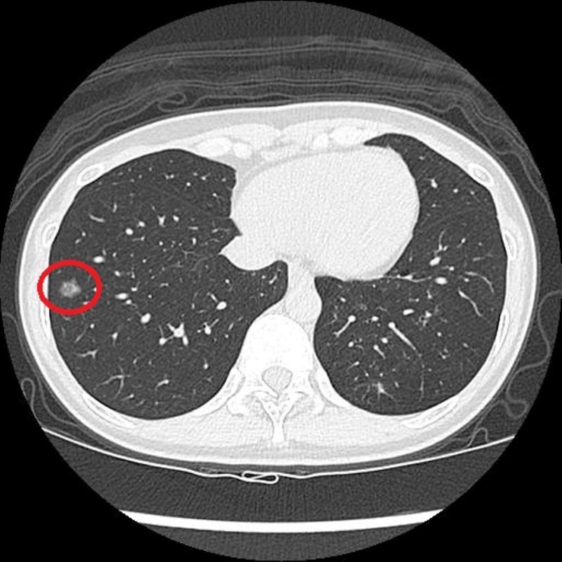LDCT檢查顯示，陳小姐右側肺部有一個1.2公分大的毛玻璃結節。（圖／台北慈濟醫院提供）