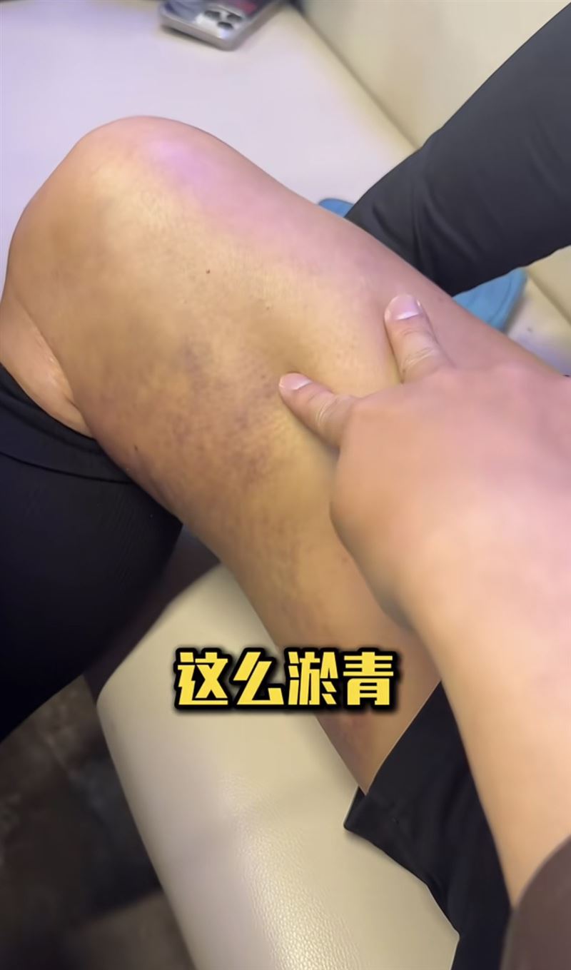 陳百祥腿上一大片瘀青。（圖／翻攝自小紅書）
