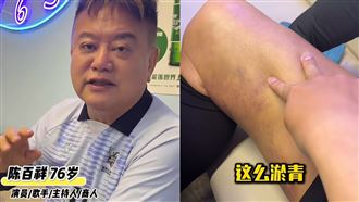 76歲港星血管爆了　褲子掀開一整片瘀黑