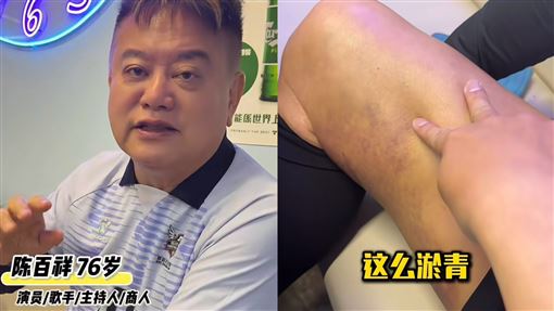 76歲港星血管爆了　褲子掀開一整片瘀黑