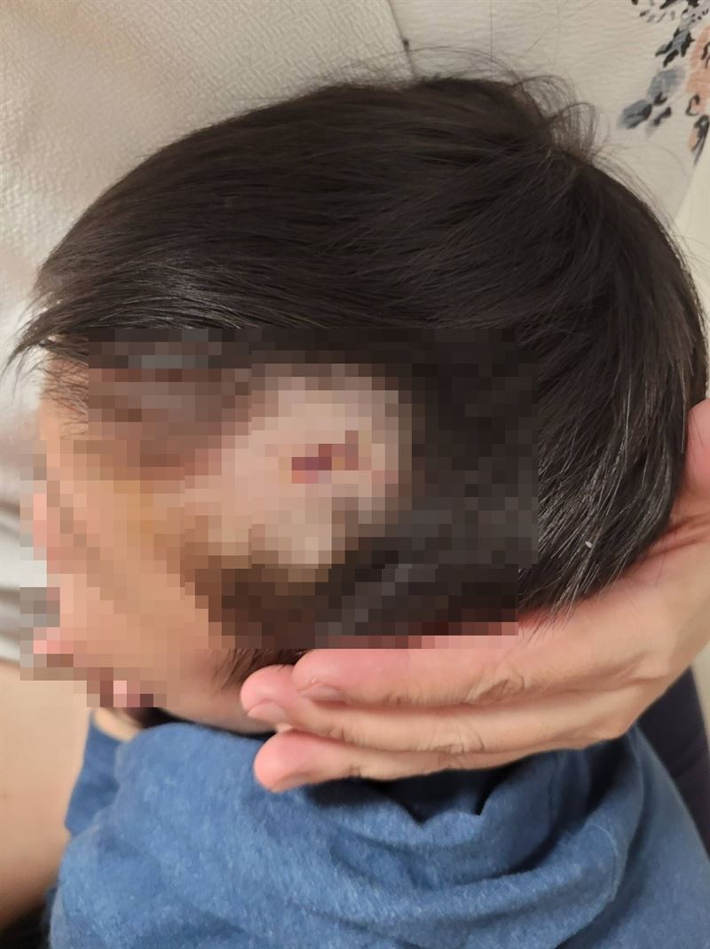 4歲男童頭部受傷後縫了數針。（圖／翻攝自臉書靠北天母幫）