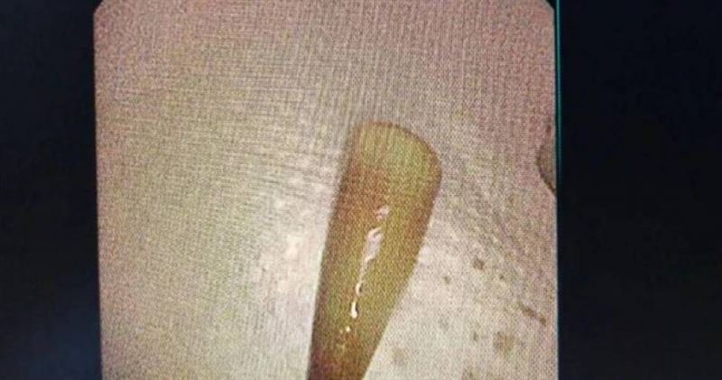 白色塑膠筆帽卡在支氣管深處，周圍已被肉芽組織包覆。（圖／翻攝自寧波晚報）