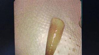 白色塑膠筆帽卡在支氣管深處，周圍已被肉芽組織包覆。（圖／翻攝自寧波晚報）