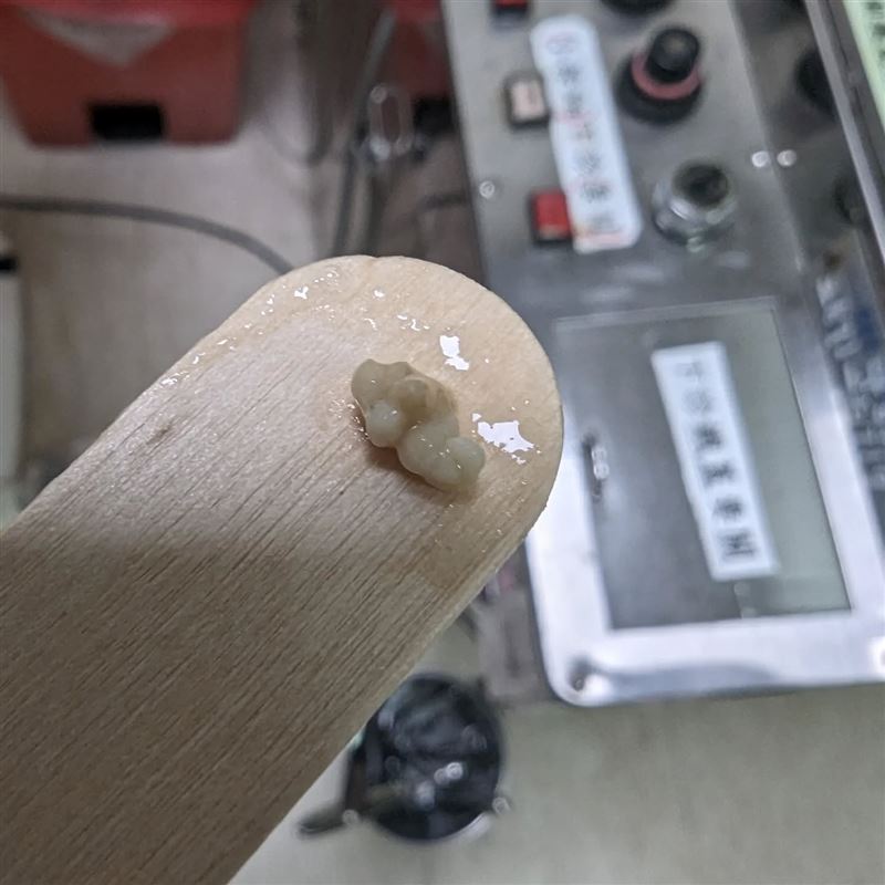 扁桃腺結石是扁桃腺慢性發炎的一種表現。（圖／李晏廷醫生一生守護臉書授權提供，未經同意請勿轉載）