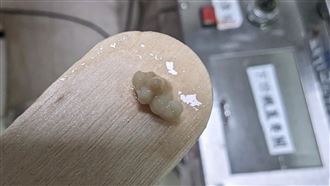 扁桃腺結石是扁桃腺慢性發炎的一種表現。（圖／李晏廷醫生一生守護臉書授權提供，未經同意請勿轉載）