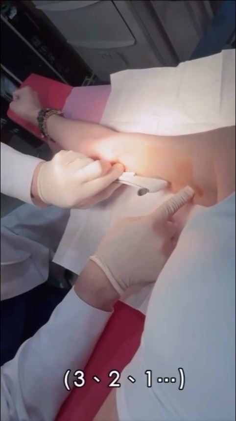 蔡允潔分享植入避孕針過程。（圖／翻攝自蔡允潔IG）