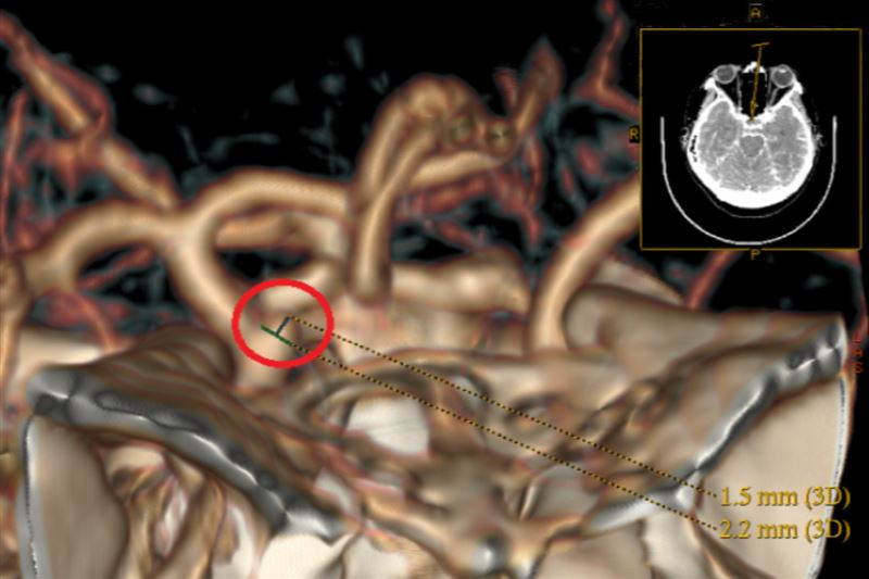 電腦斷層血管攝影顯示，患者內頸動脈與眼動脈之間潛藏一顆2.4毫米大的水滴型動脈瘤。（圖／台北慈濟醫院提供）