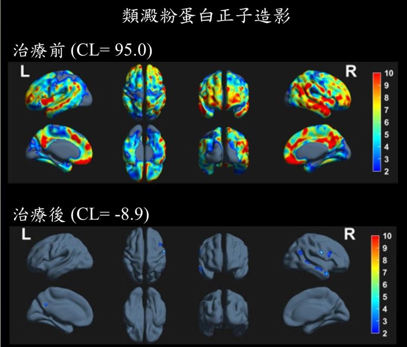 患者療程持續半年後，正子斷層影像顯示腦中異常蛋白清零。（圖／土城醫院提供）