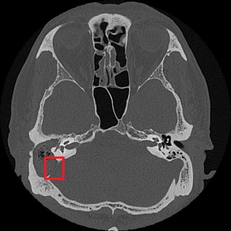 紅框處可見與後顱窩相隔的骨板被膽脂瘤侵蝕。（圖／台北慈濟醫院提供）