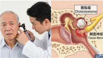 耳朵流膿「右臉突癱」驚：大腦骨頭被吃了