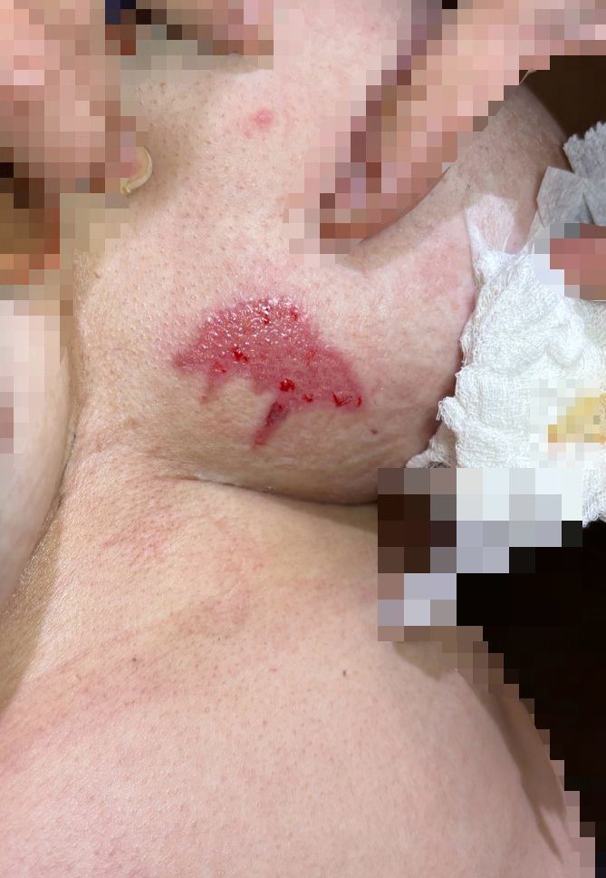 台中婦人把手握式暖暖包放在乳溝取暖，9小時後取出竟造成低溫燙傷，皮膚已脫落、滲出組織液。(圖／茂盛醫院提供)