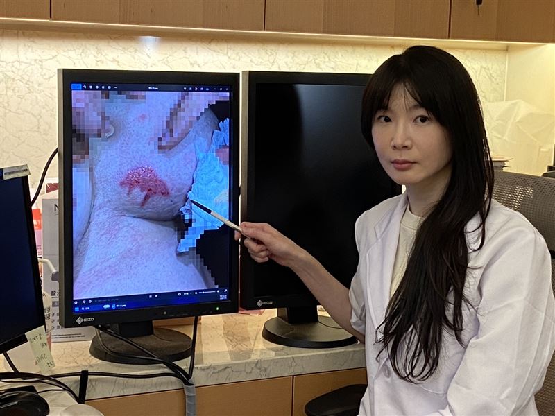 婦人表示9小時未感覺到熱燙或不適，皮膚科醫師表示，有人知覺比較遲鈍，使用暖暖包要選較低溫的避免燙傷。(圖／茂盛醫院提供)