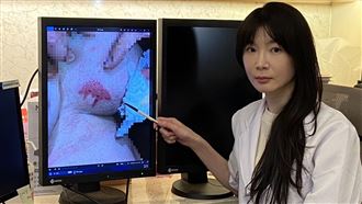 乳溝夾暖暖包9小時　她驚見皮膚脫落流湯