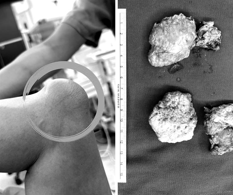 痛風石不斷在全身關節處增生，讓患者相當崩潰。（圖／長安醫院提供）