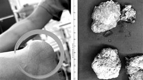 中年男痛風石，壓到神經手麻，微創手術清出5公分痛風石（圖／長安醫院提供）