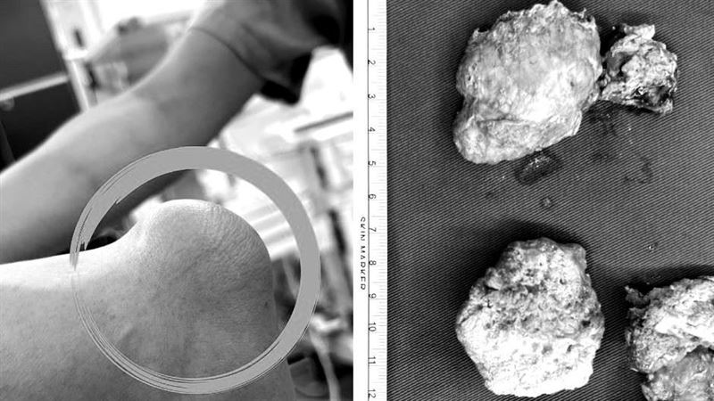 50歲男雙手麻20年　超音波刀切5CM痛風石