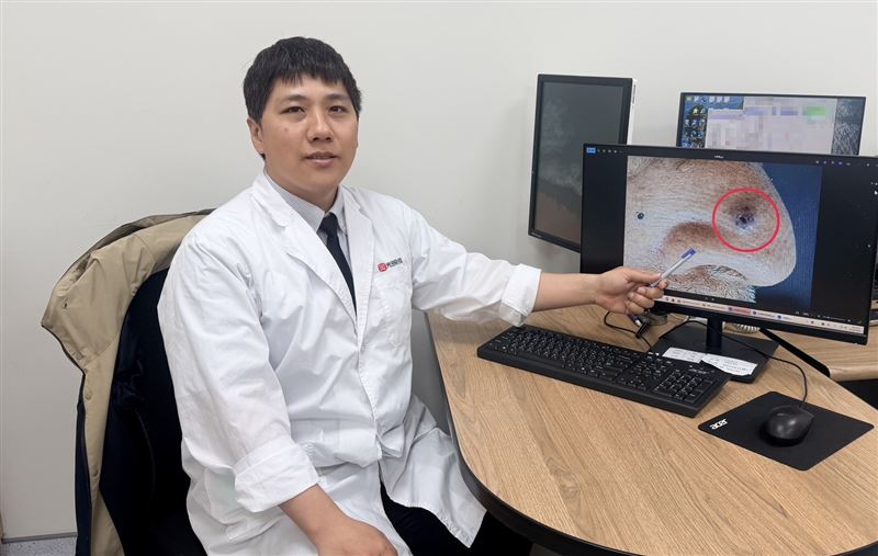 70歲老翁鼻子上長出一顆小黑點，不以為意，沒想到過了兩年黑點變大還出血，就醫檢查驗出皮膚癌。(圖／光田醫院提供)