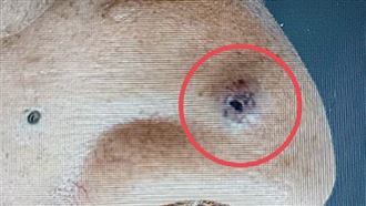 鼻子長黑點以為是痣！70歲翁拖2年竟變癌