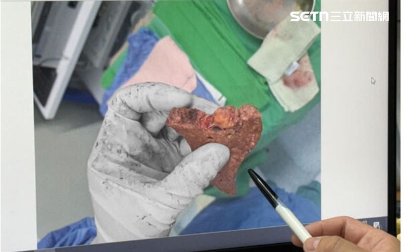 婦人的肝臟高達6成被脂肪包覆,宛如肥美的「鵝肝」,最終切下一塊重達223克、脂肪肝,整個肝臟大約6成全是油。(圖/院方提供)