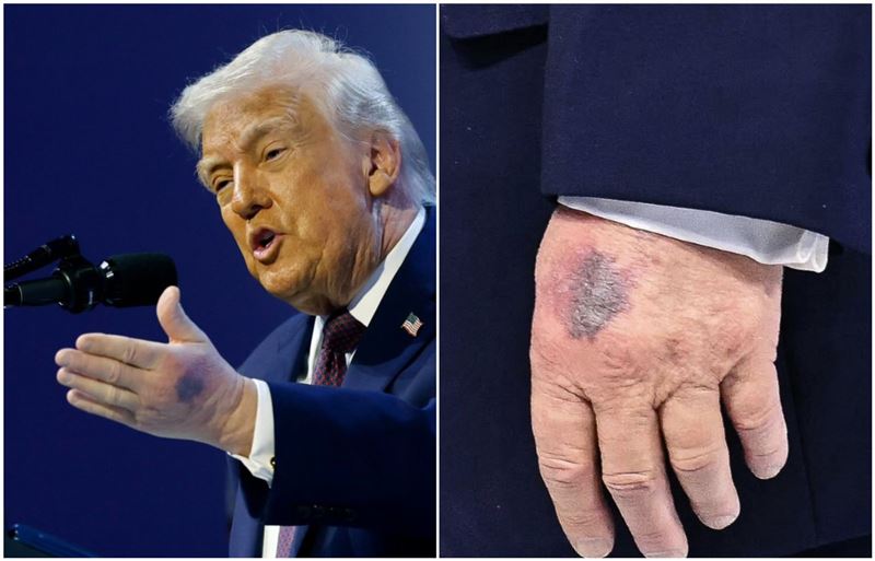 川普在達佛斯出席「和平委員會」，被拍到左手背出現大片瘀青。（翻攝X@jacksonhinklle）