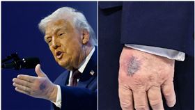 川普在達佛斯出席「和平委員會」，被拍到左手背出現大片瘀青。（翻攝X@jacksonhinklle）