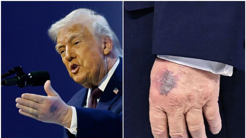 川普左手驚見大片紫斑！白宮：撞到桌角啦