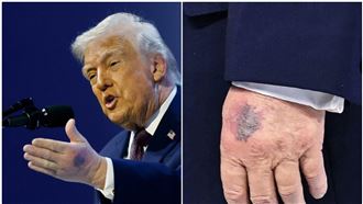 川普左手驚見大片紫斑！白宮：撞到桌角啦