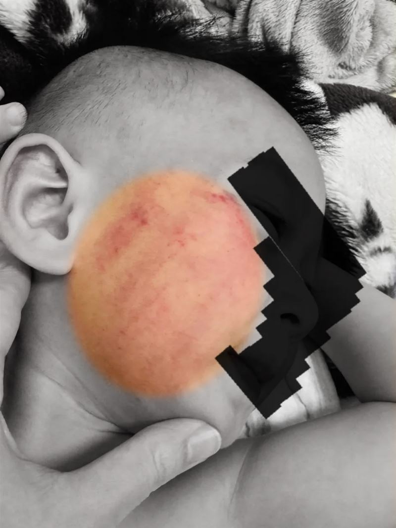 即便已經過了三天，男童臉上仍有明顯瘀痕。（圖／家屬授權提供）