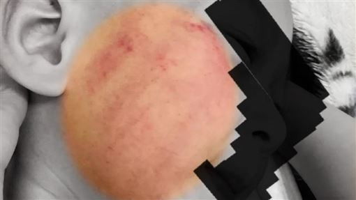 竹縣私幼師「虐打1小時」2歲童滿臉傷痕