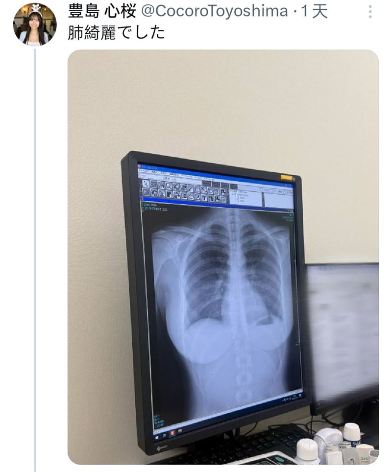 豐島心櫻曬出胸部X光照。（圖／翻攝自X）