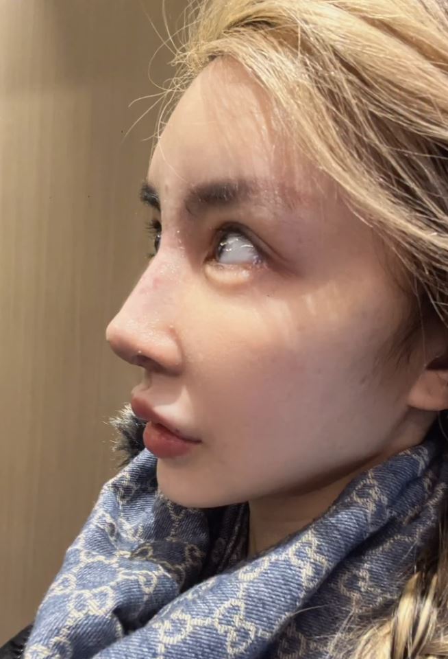 雪碧分享自己整形過程。(圖/翻攝自雪碧IG)