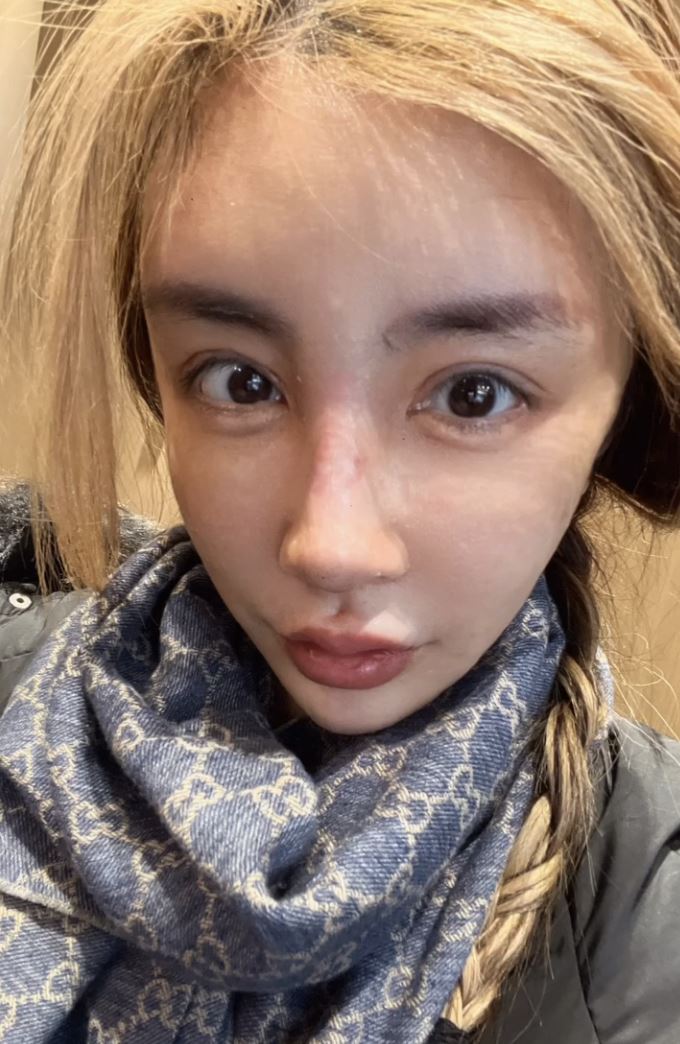 雪碧分享自己整形過程。(圖/翻攝自雪碧IG)