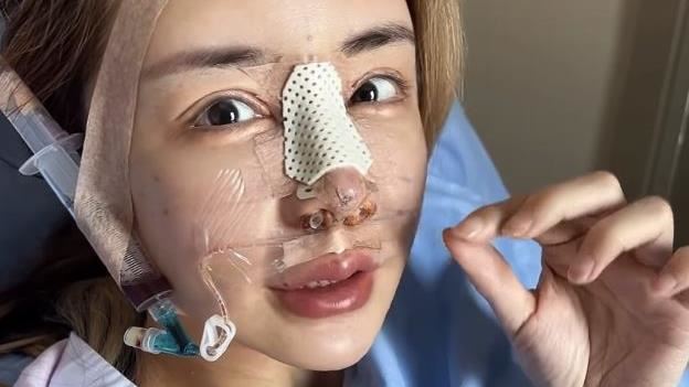 雪碧分享自己整形過程。(圖/翻攝自雪碧IG)