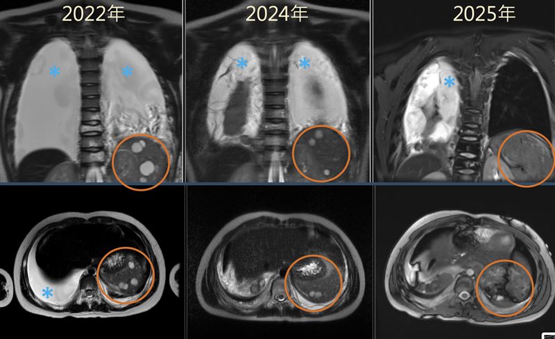 詹小弟經治療後雙側肋膜積液顯著減少、脾臟囊腫幾乎消失。（圖／北榮提供）