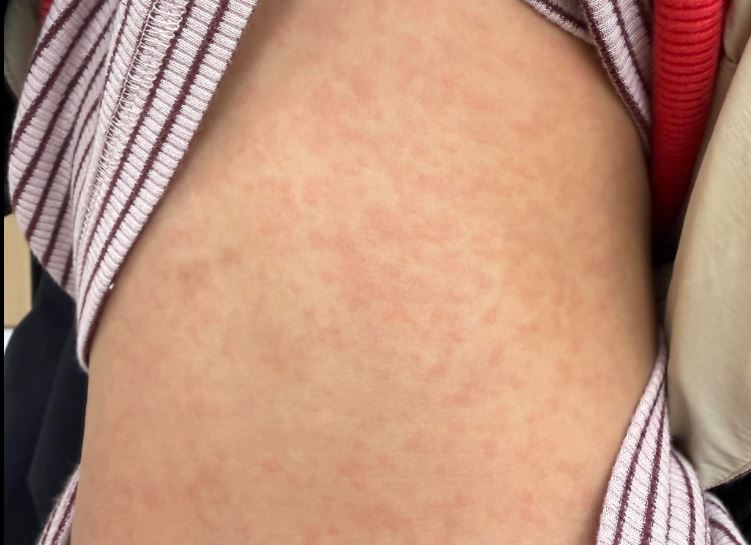 小孩背後出現紅疹，醫師點名元凶是「刷毛」毛衣。（圖／取自雙寶爸的小宇宙｜兒童感染科 顏俊宇醫師）