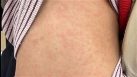 小孩背後出現紅疹，醫師點名元凶是「刷毛」毛衣。（圖／取自雙寶爸的小宇宙｜兒童感染科 顏俊宇醫師）