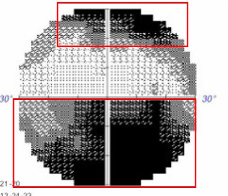 王女士的視野檢查影像，視力異常的右眼，紅框部分可見視野明顯受限。（圖／台北慈濟醫院提供）