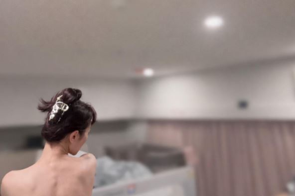 蔡允潔（蔡小潔）背部全裸針灸。（圖／翻攝自蔡小潔臉書）