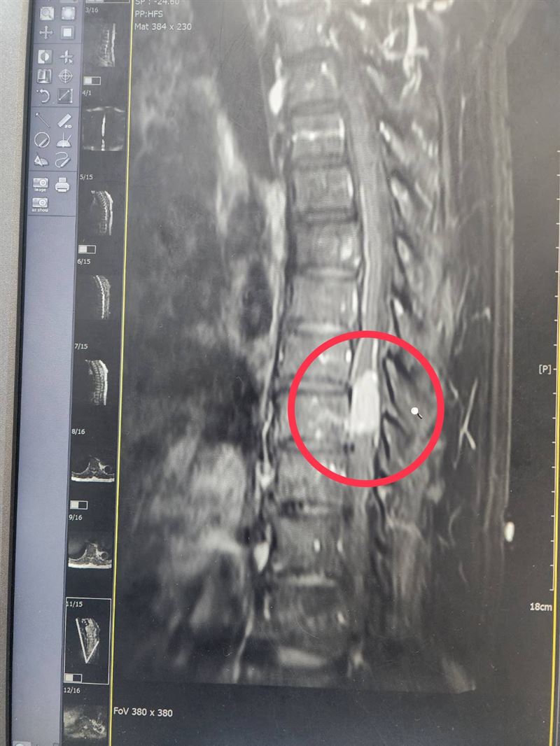 6旬男腳無力復健沒用,醫師檢查發現長了「胸椎腦膜瘤」壓迫脊髓。(圖/耕莘醫院提供)